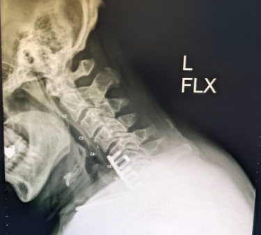 Name:  Neck X-Ray, L-Flex, Jun 2022 - cropped.jpg
Views: 1225
Size:  30.2 KB